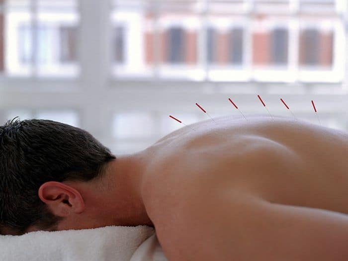 Risks of Acupuncture